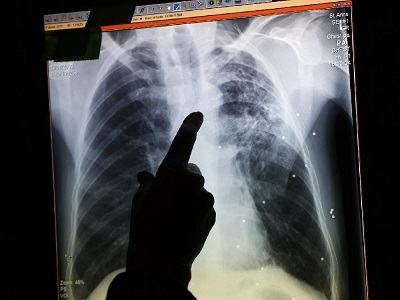 Tuberculosis and its effect on Australian visas from Philippines