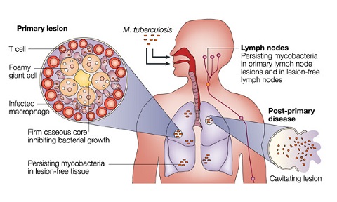 Part of the visa medical for Australian visa applications is the diagnosis of tuberculosis, or TB, from xray examination