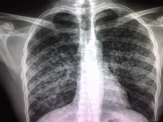 xray of lungs with suspected tuberculosis, aka tb